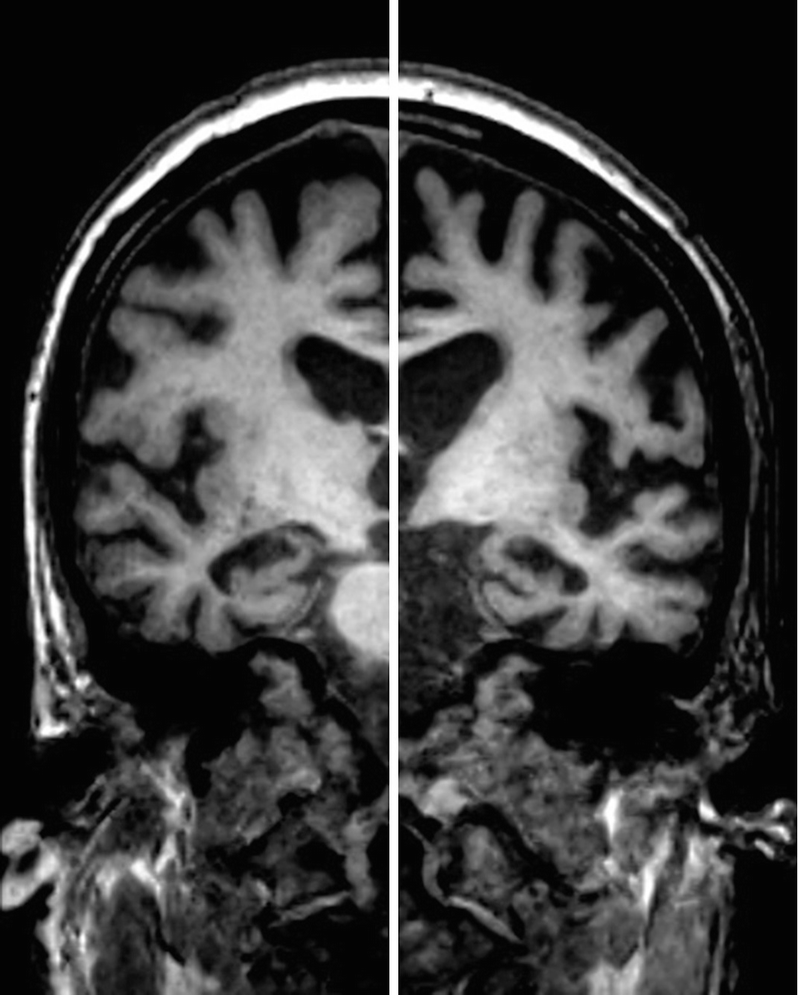 Dois cortes coronais de ressonância magnética T1 de uma mulher de 70 anos com demência clínica, mostrando atrofia hipocampal bilateral grau MTA 3.
