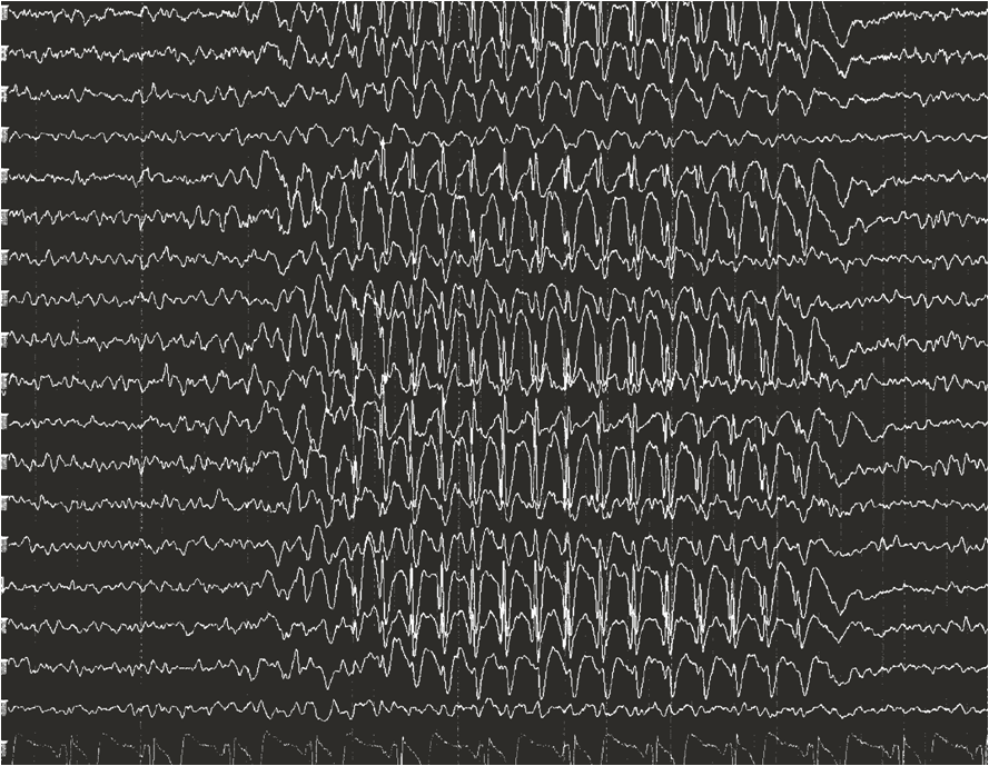 EEG 3 Hz ponta-onda (ausência típica)