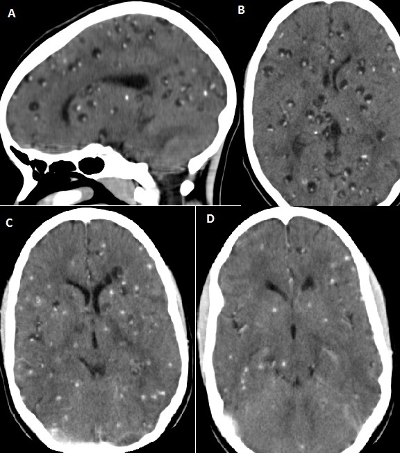Tomografia de crânio com calcificações parenquimatosas de neurocisticercose — achado estrutural que eleva o risco de recorrência e abre a Via 2.