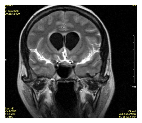 RM encefálica em FLAIR pós-contraste com realce leptomeníngeo no tentório e convexidade parietal e ventrículos dilatados, compatível com meningite aguda.