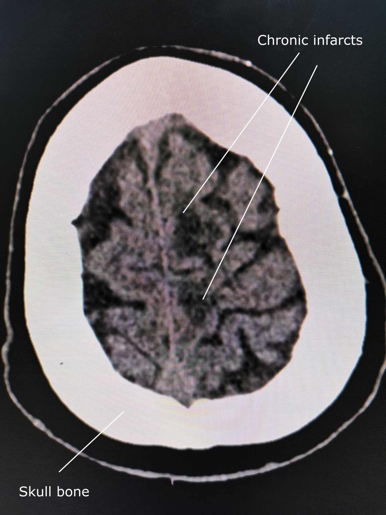 Tomografia de crânio mostrando infarto crônico na região parietal alta esquerda, sequela cicatricial de AVE isquêmico — causa comum de epilepsia de início no idoso.