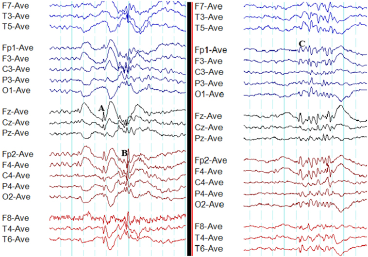 EEG ponta-onda ~3 Hz (ausência típica) para tríptico mioclonia/atonia/ausência