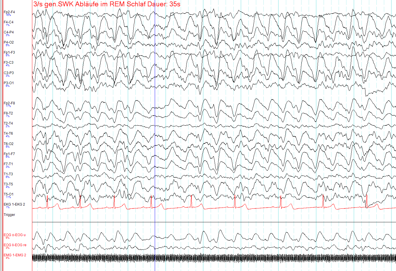 Traçado de EEG multipolar com complexos ponta-onda generalizados a cerca de 3 por segundo, recorte de 35 segundos, assinatura eletrográfica do complexo ponta-onda.