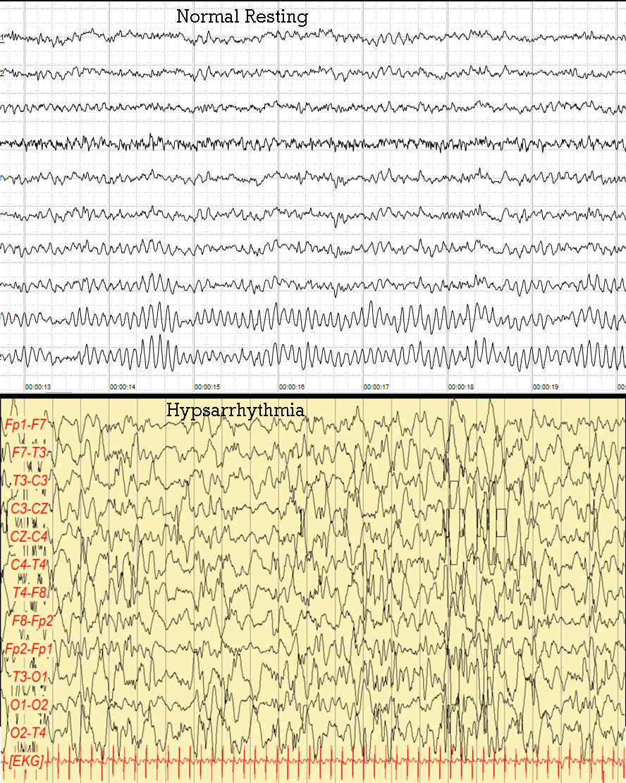 Comparação de traçados de EEG: painel com ritmo alfa normal e painel com padrão de hipsarritmia, atividade caótica de alta amplitude com pontas e ondas multifocais em lactente.