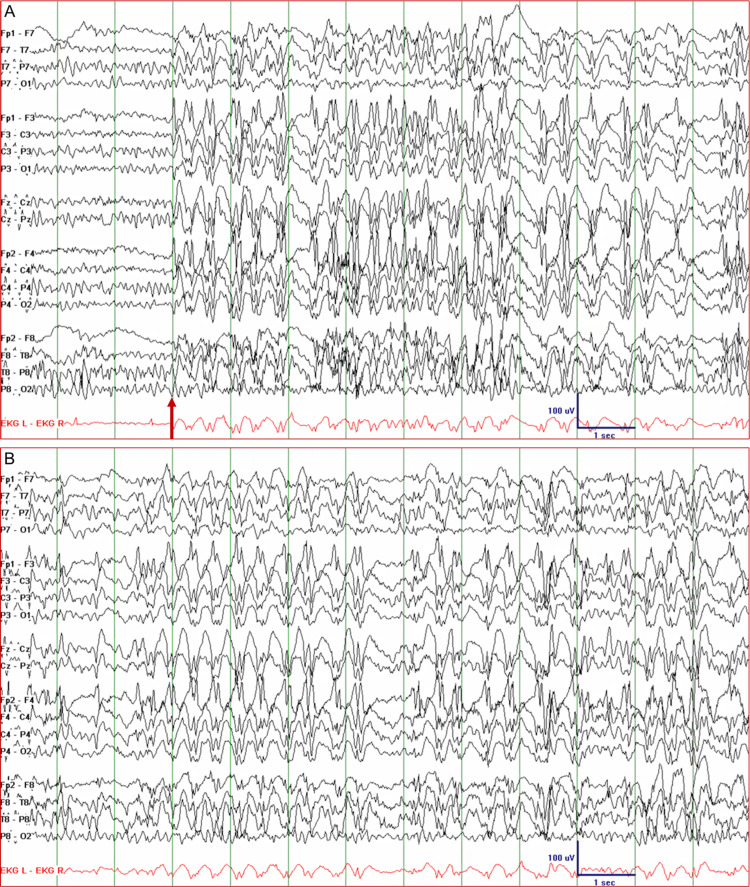 EEG ponta-onda ~3 Hz (ausência)