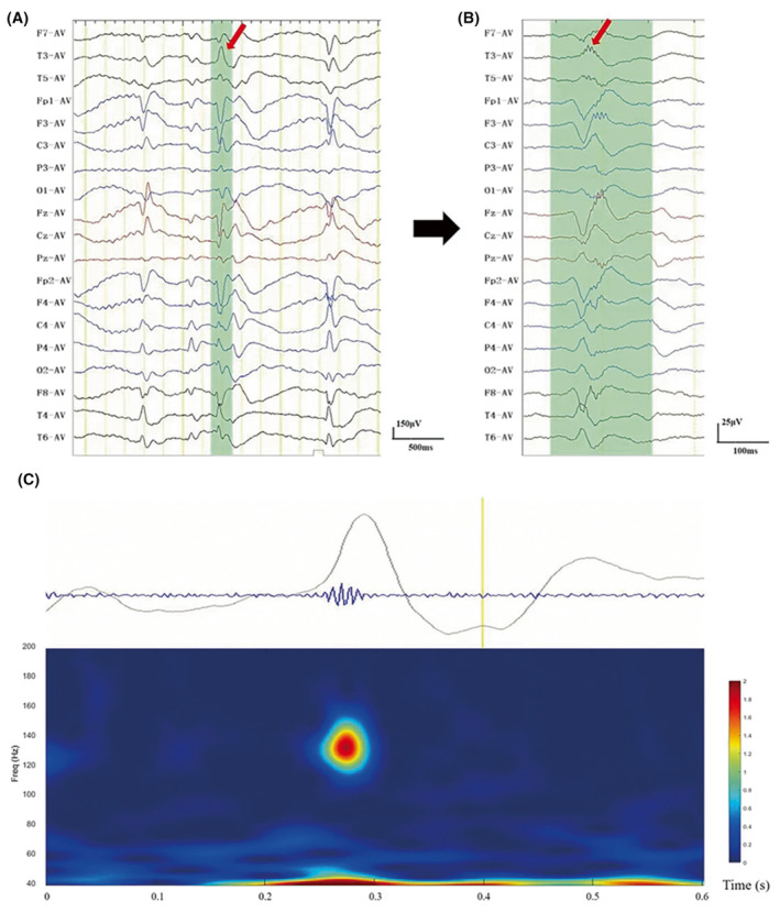 Traçados de EEG com descargas epileptiformes centro-temporais em paciente com BECTS, painel A em banda larga, B filtrado para high-frequency oscillations e C tempo-frequência em T3.