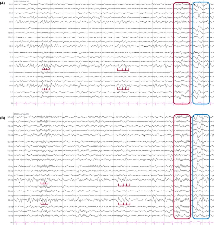 Traçado de EEG em adolescente de 14 anos com epilepsia mioclônica juvenil mostrando complexos poliponta-onda generalizados a 3,5 a 4 Hz, painéis A em montagem bipolar e B em referencial média comum.