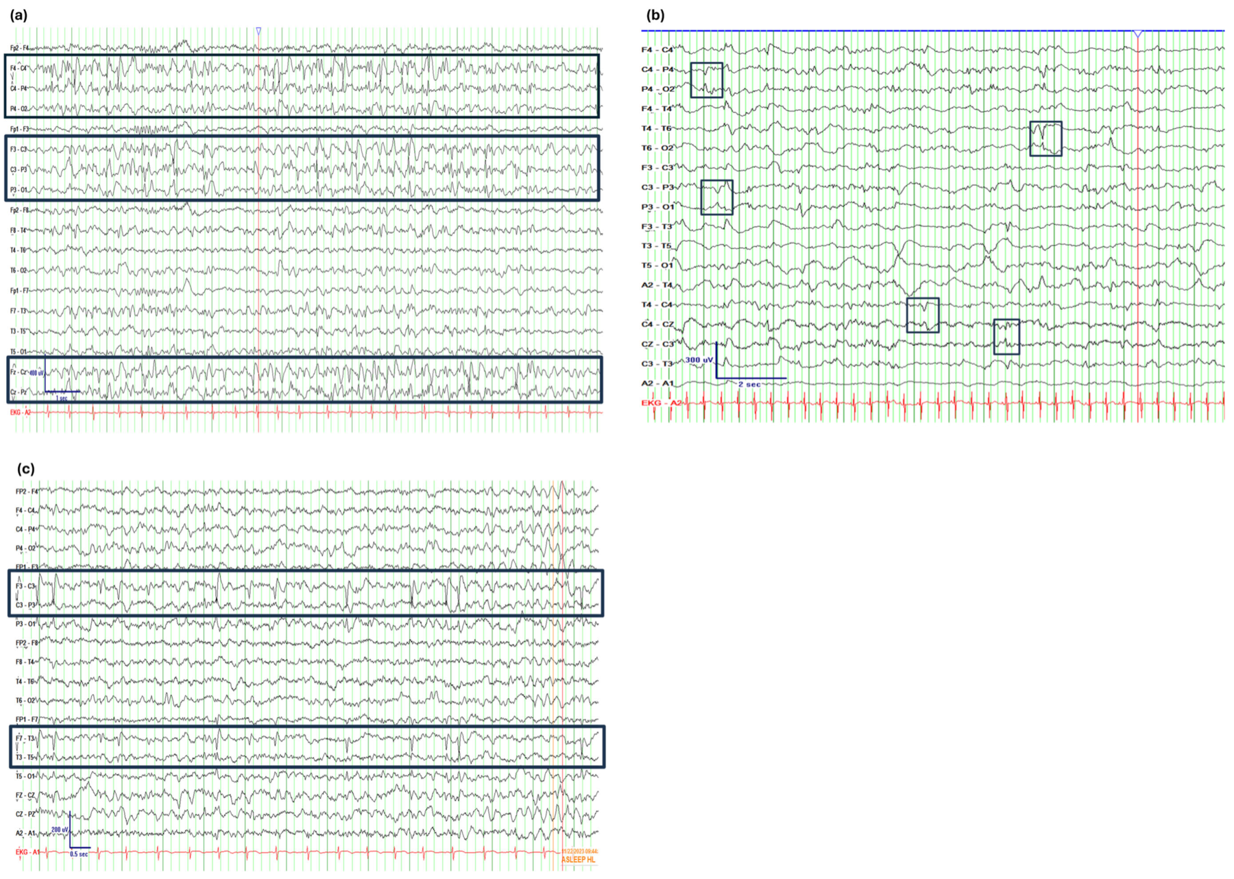 Traçado de EEG com descargas epileptiformes interictais centro-temporais frequentes durante o sono, assinatura eletrográfica das espículas da rolândica exacerbadas no sono.