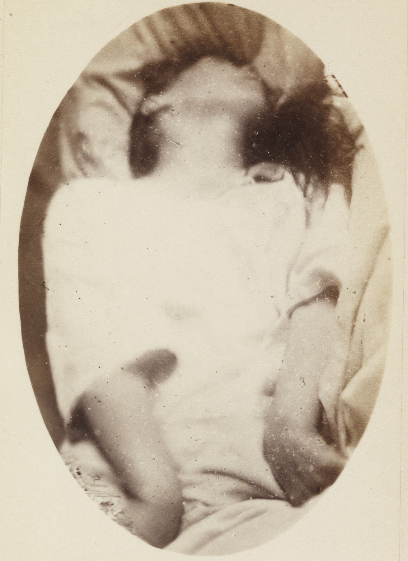 Gravura de atlas clínico histórico: paciente em período epileptoide da grande crise convulsiva, com legenda original Attaque — Période Épileptoïde.
