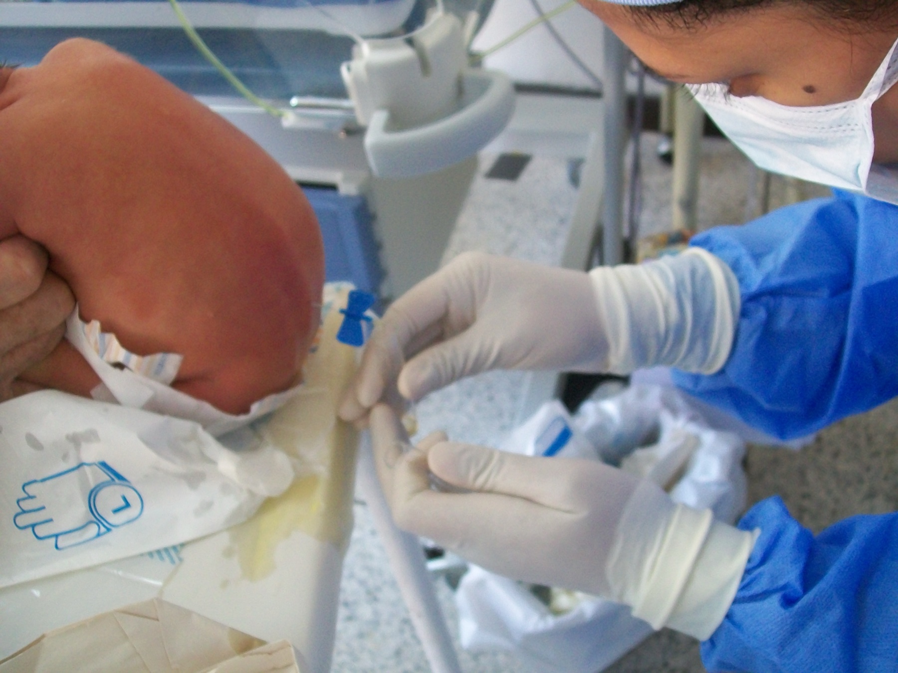 Punção lombar em recém-nascido em unidade de cuidados intermediários neonatais; a fralda cobre a genitália e a posição lateral fletida expõe o dorso lombar.