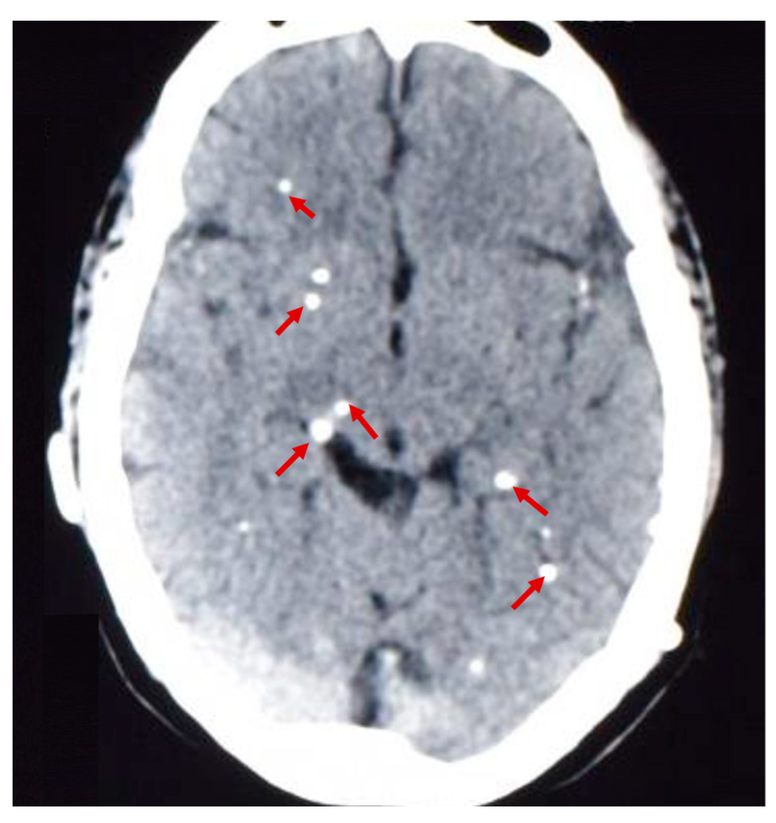 Tomografia de crânio axial sem contraste mostrando múltiplos nódulos calcificados no parênquima cerebral, compatíveis com neurocisticercose na fase nodular calcificada; setas vermelhas marcam as calcificações.