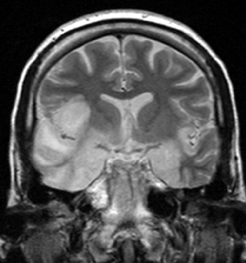 Ressonância magnética cerebral em corte coronal, ponderação T2, na fase aguda de encefalite por herpes simples: hipersinal e edema nos lobos temporais, ínsulas e giro frontal inferior direito.