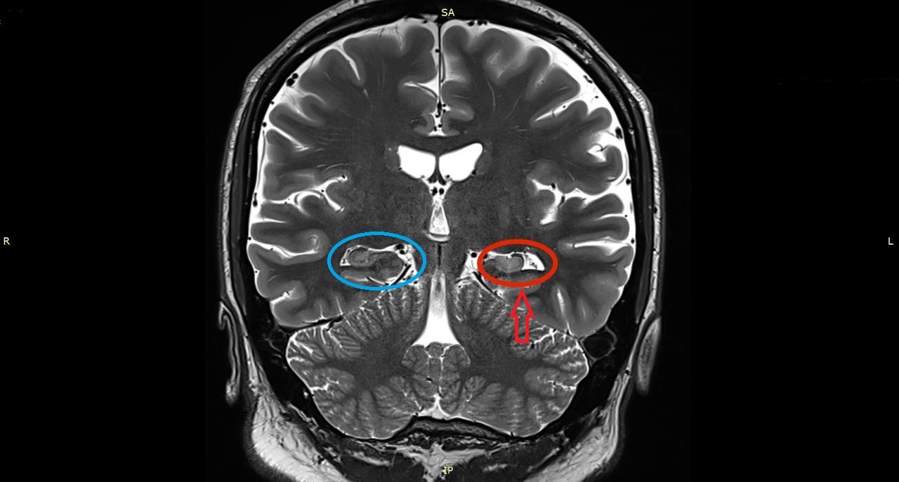 RM encefálica: esclerose hipocampal esquerda com perda de volume em relação ao hipocampo direito — achado etiológico de epilepsia estrutural.