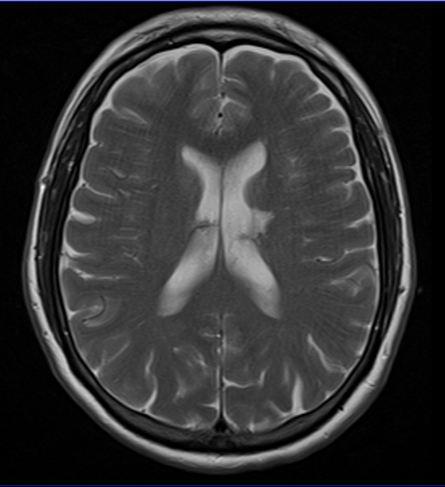 RM encefálica: infarto lacunar crônico em coroa radiada esquerda — sequela isquêmica, terreno epileptogênico.
