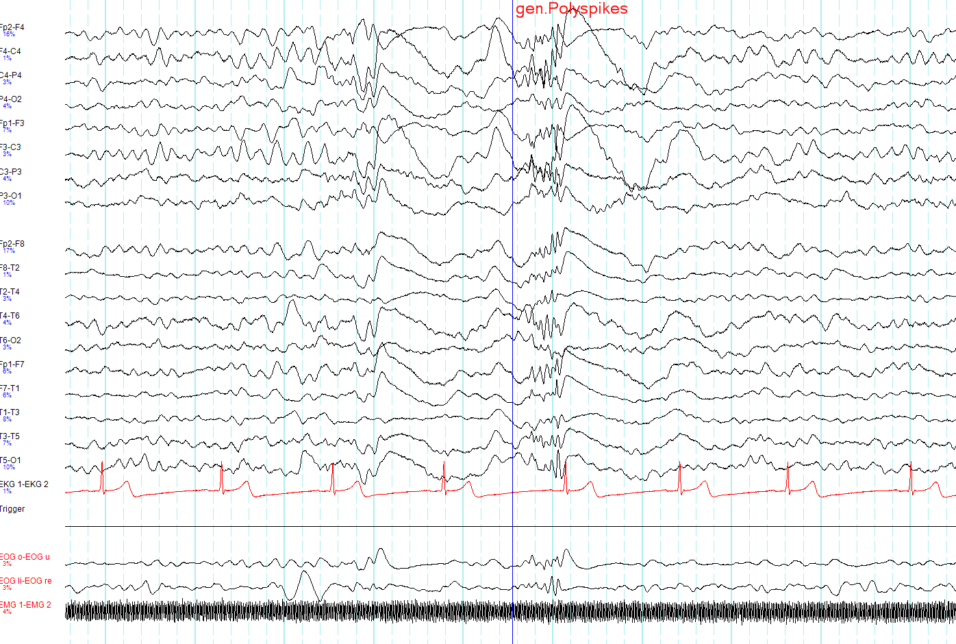 EEG: descarga generalizada bilateral com complexos poly-spikes em múltiplos canais de ambos os hemisférios.
