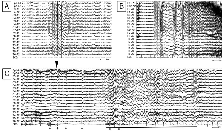 EEG ictal de crise tônico-clônica generalizada: sequência com onset de ondas rápidas generalizadas após polispikes.