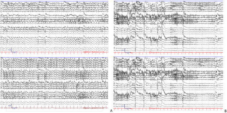 EEG em status de ausência atípico: painéis A mostram ritmo generalizado de 3 a 4 Hz com ondas agudas durante a vigília, consistente com crise eletroclínica prolongada sem convulsão; painéis B mostram desaparecimento da atividade rítmica com retorno ao baseline clínico.