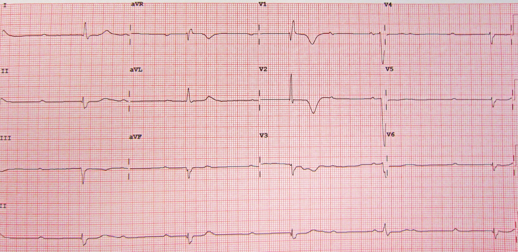 ECG de 12 derivações mostrando bloqueio atrioventricular completo (terceiro grau): ondas P dissociadas dos complexos QRS, frequência ventricular baixa, QRS largos.