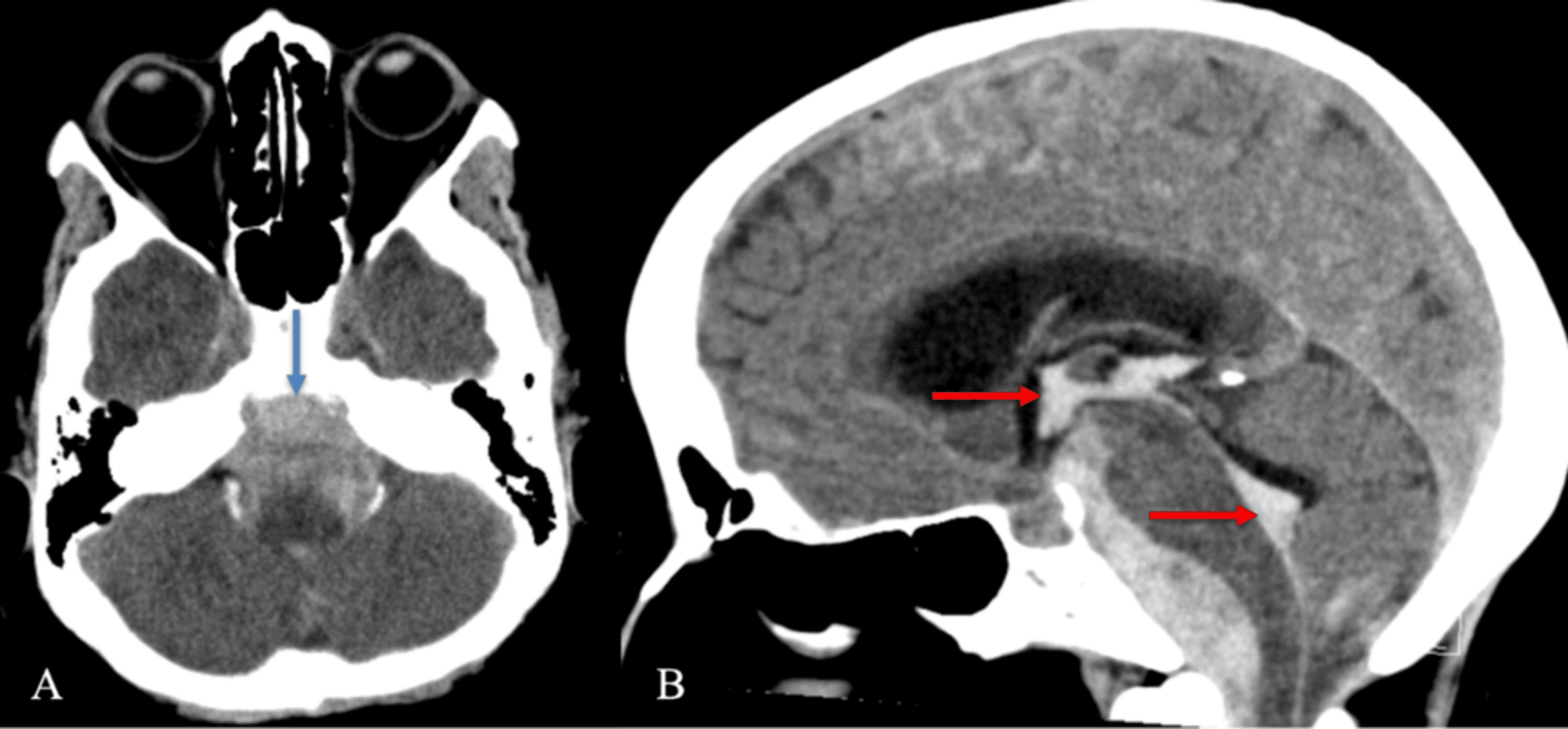 Composição de duas tomografias de crânio sem contraste da mesma paciente: à esquerda, corte axial com seta azul sobre sangue hiperdenso na cisterna prepontina e extensão às cisternas basais; à direita, corte sagital com setas vermelhas sobre sangue no terceiro e quarto ventrículos, com discreta dilatação ventricular.