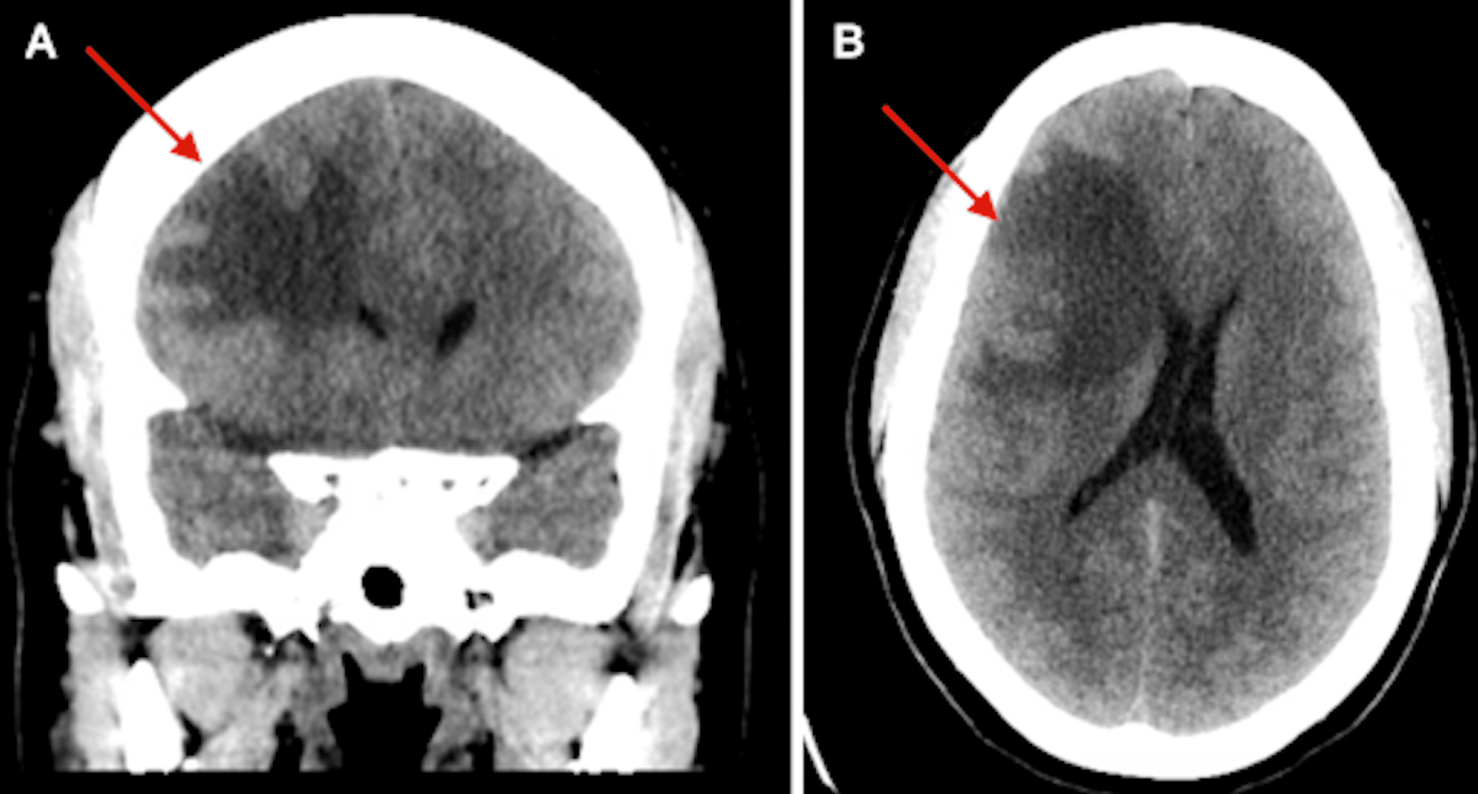 Neuroimagem axial com grande massa frontal, compressão ventricular e desvio contralateral da linha média