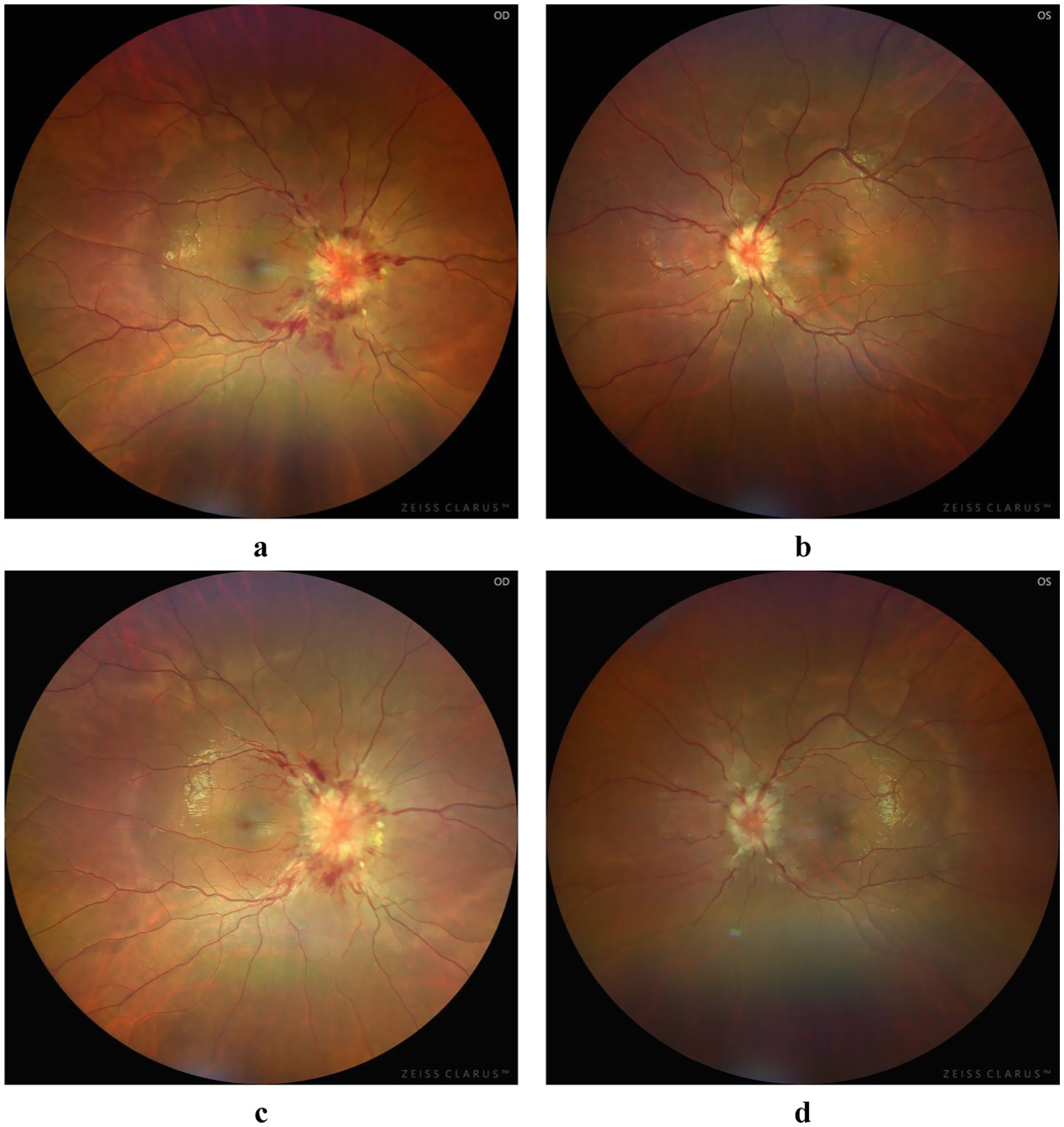 Grade de quatro fotografias de fundo de olho. Acima, olho direito e esquerdo com papiledema bilateral, discos elevados e de bordas apagadas, congestão venosa e hemorragias peripapilares. Abaixo, os mesmos olhos após tratamento, com melhora parcial.
