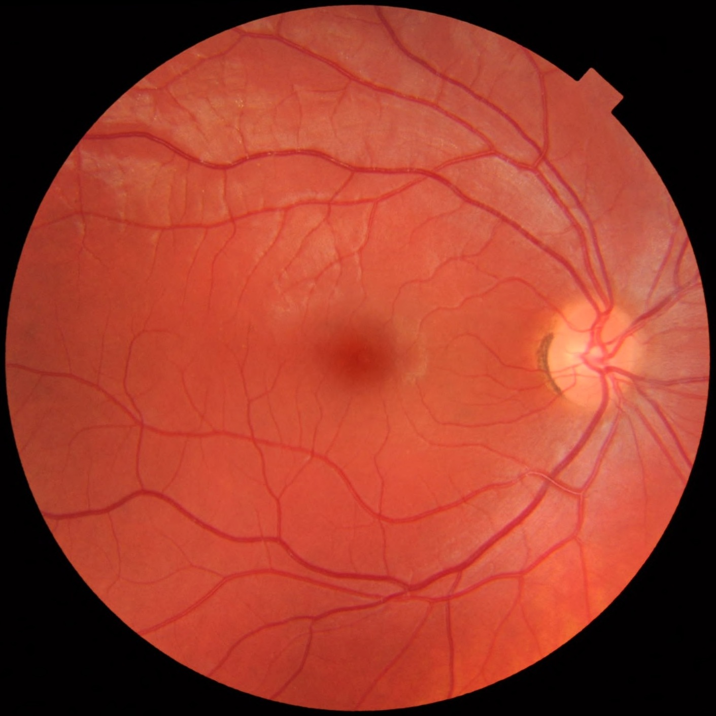 Fotografia de fundo de olho direito normal, com disco óptico rosado à direita do quadro, margens nítidas e escavação fisiológica; mácula central escura e vasos retinianos sem obscurecimento por edema ou hemorragia peripapilar.