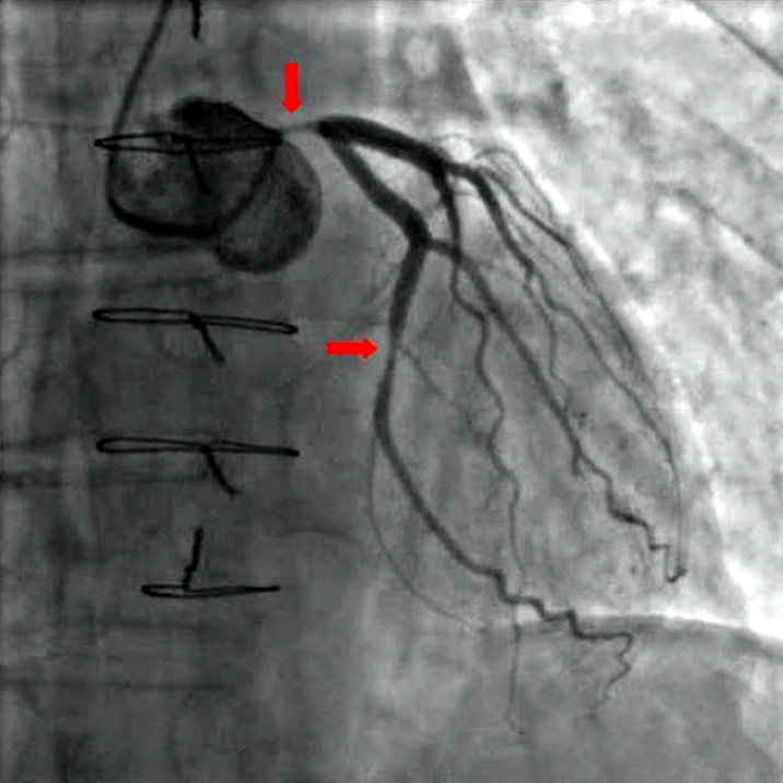 Angiografia coronária mostrando estenose crítica no tronco da coronária esquerda e na circunflexa, com setas indicando a placa.