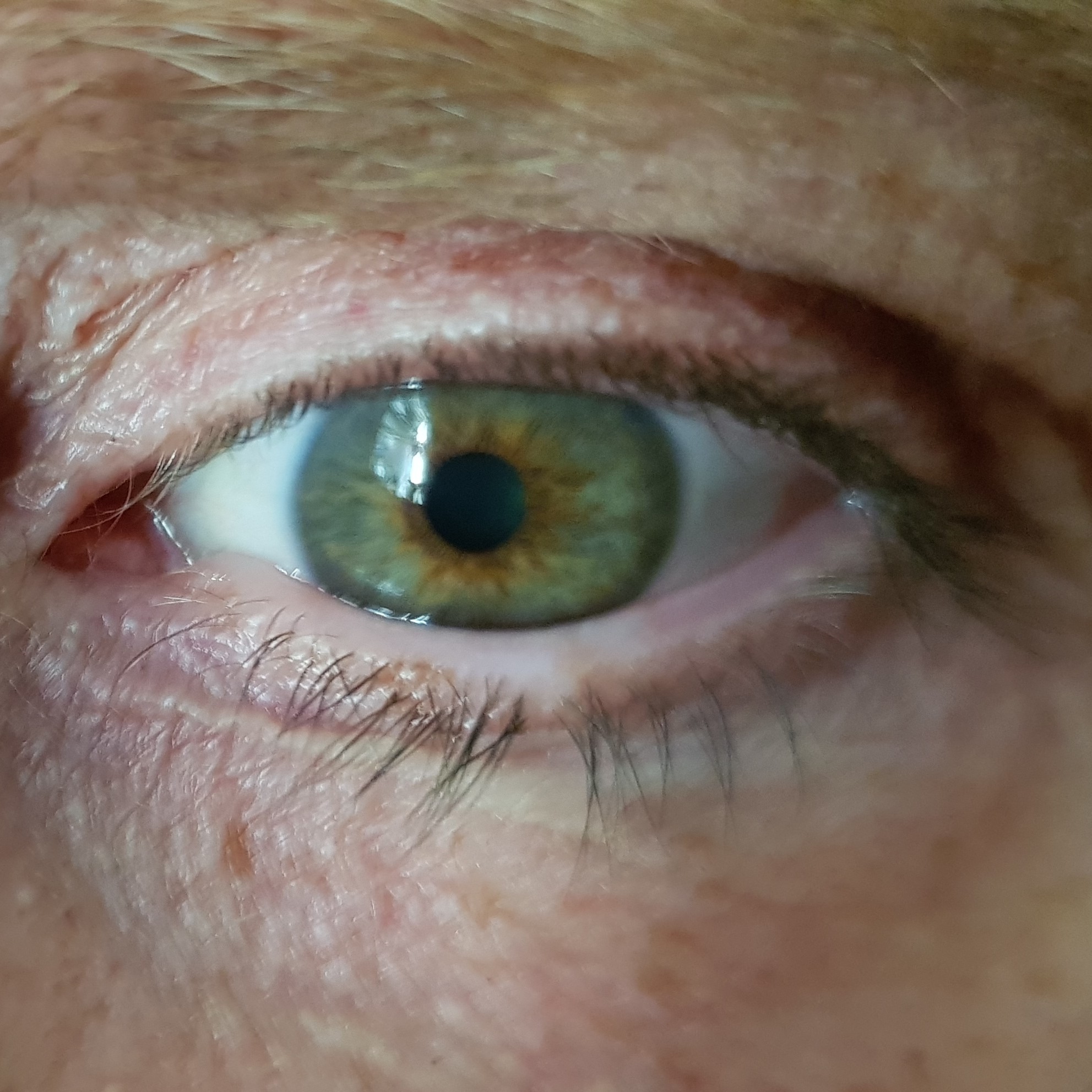 Foto clínica durante crise de cefaleia em salva mostrando hiperemia e injeção conjuntival ipsilaterais, com o paciente solicitado a abrir os olhos.
