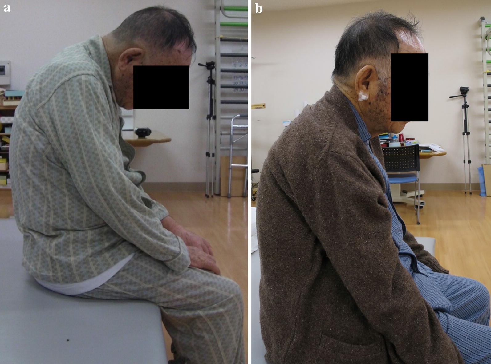 Fotografia clínica de paciente com cabeça caída em flexão cervical extrema (dropped head), em postura chin-on-chest.