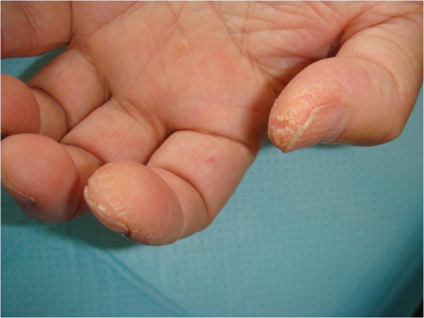 Mãos com fissuras, hiperqueratose e descamação em polpa do polegar e face radial do indicador, padrão de mãos de mecânico.