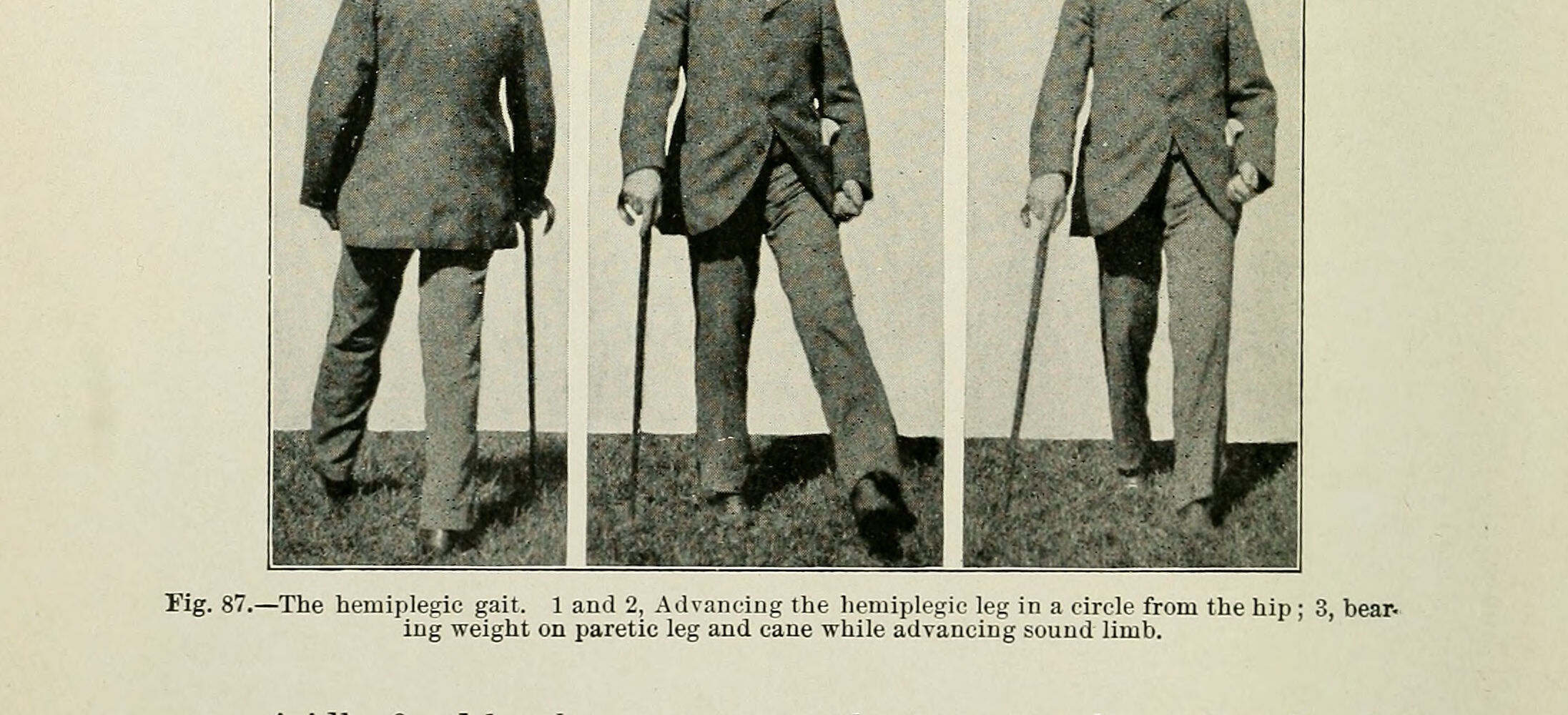 Ilustração histórica de marcha hemiplégica espástica, com membro superior fletido e membro inferior rígido em circundução.