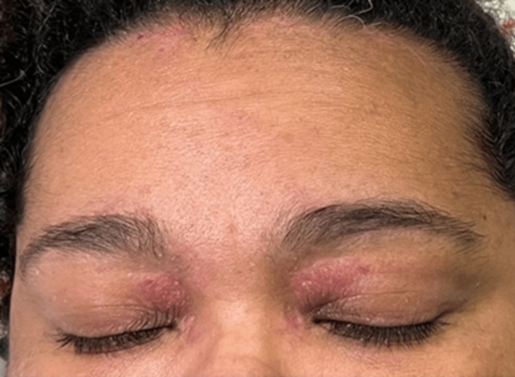 Close periocular com placas violáceas bilaterais e edema de pálpebras superiores, compatível com heliótropo.