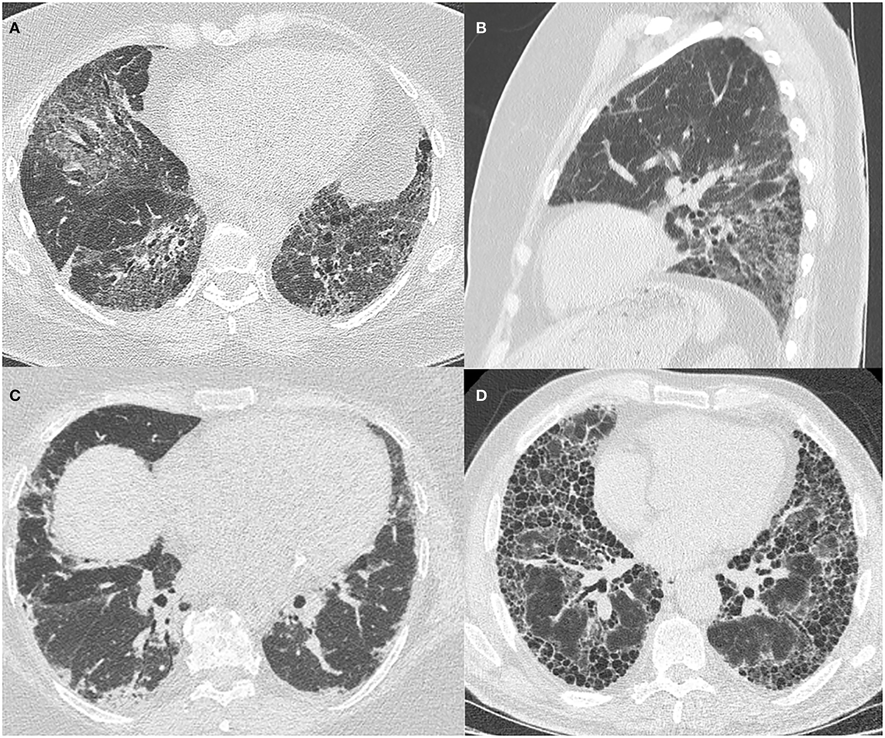 Painéis de TC de tórax de alta resolução mostrando padrões de doença pulmonar intersticial em pacientes anti-Jo-1 positivos.