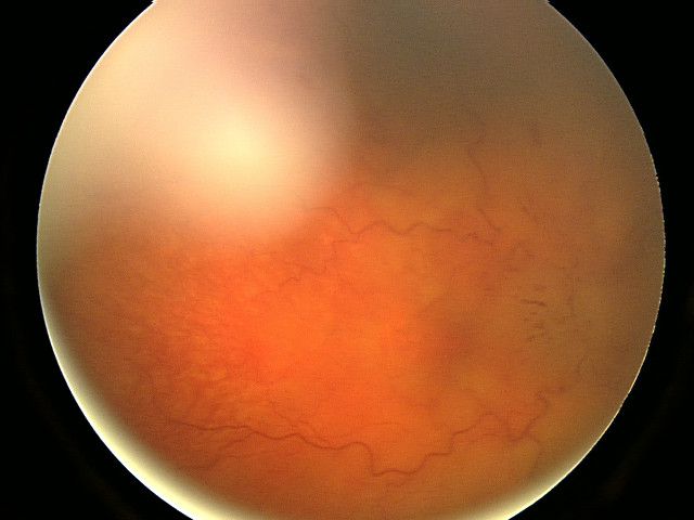 Fundo de olho do olho direito mostrando papila óptica com edema acentuado (papiledema).