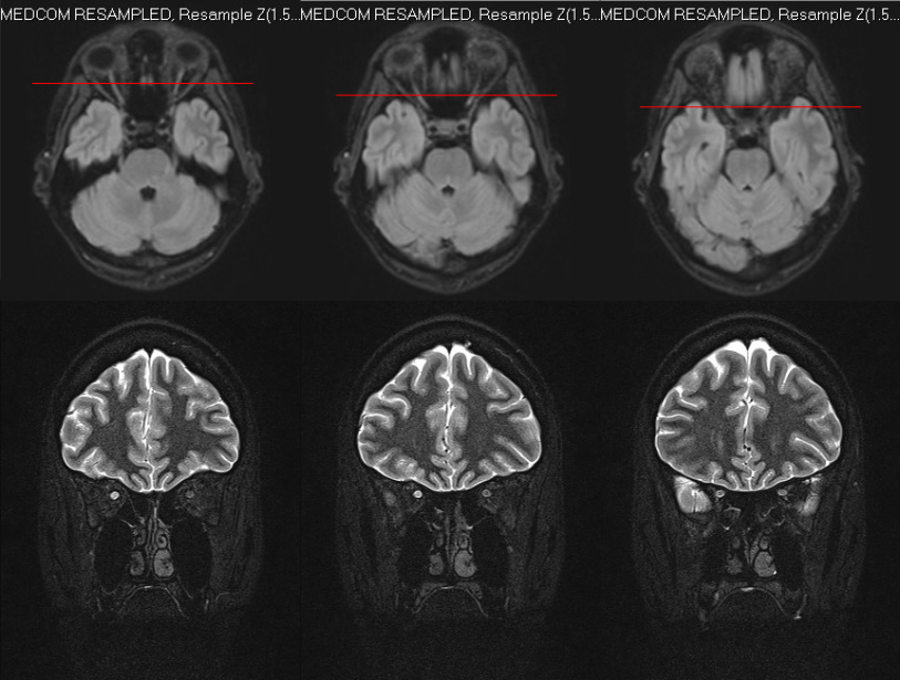 Ressonância magnética mostrando nervo óptico direito hiperintenso (neurite) em contraste com o contralateral.