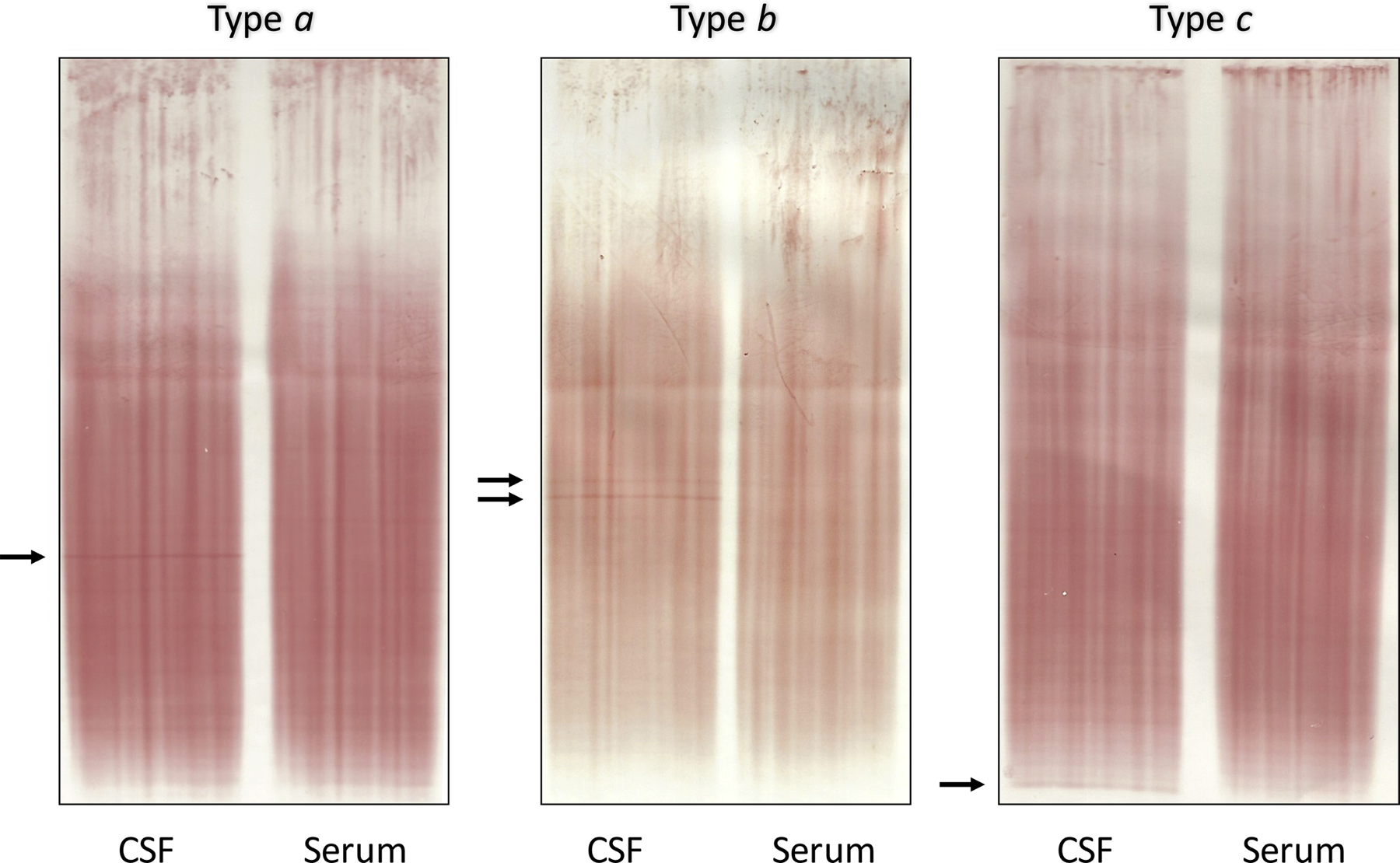Eletroforese por focalização isoelétrica com immunoblot IgG mostrando bandas oligoclonais limítrofes no líquor comparado ao soro.