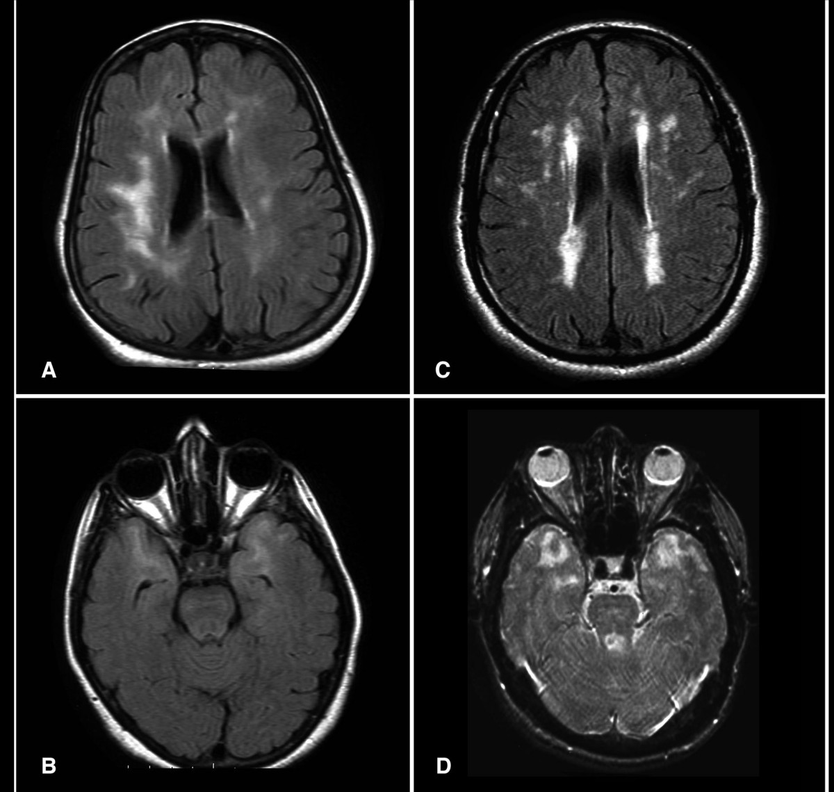 Lesões periventriculares de substância branca (RM FLAIR axial)