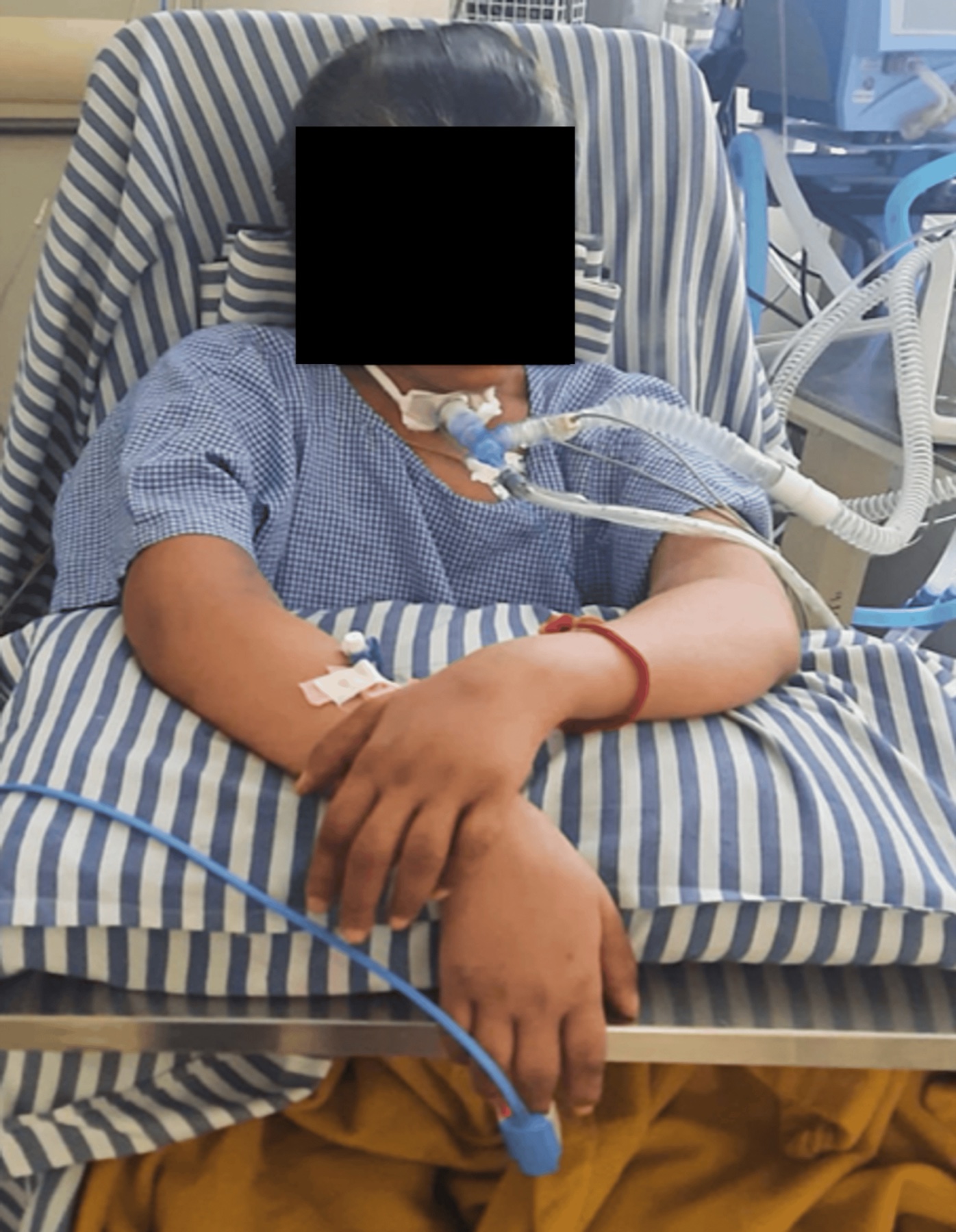 Paciente adulta com síndrome de Guillain-Barré sentada no leito com assistência: membros superiores em repouso flácido sobre travesseiro, suporte ventilatório por traqueostomia; rosto tarjado.