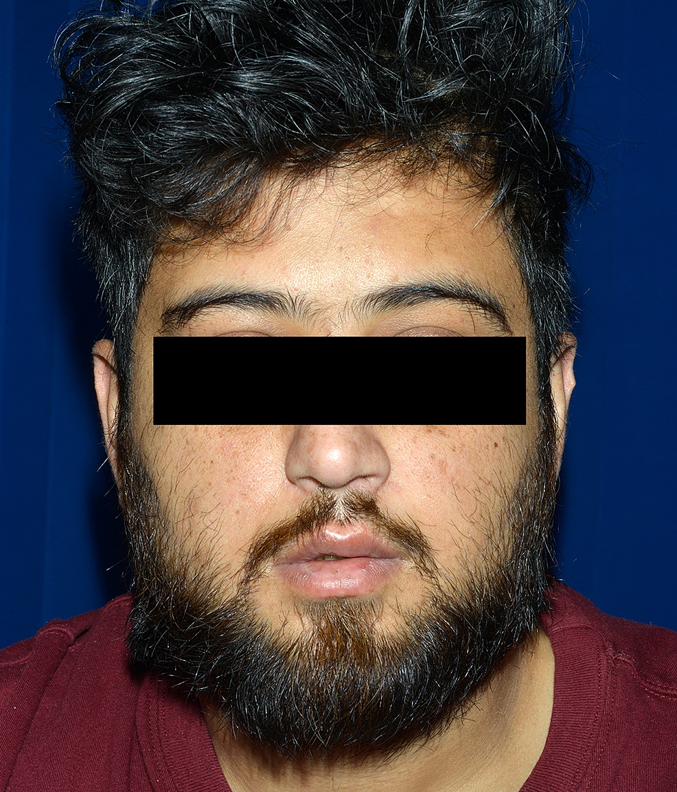 Adulto com paralisia facial bilateral em esforço de elevar as sobrancelhas: ausência de rugas frontais nos dois lados; olhos tarjados.