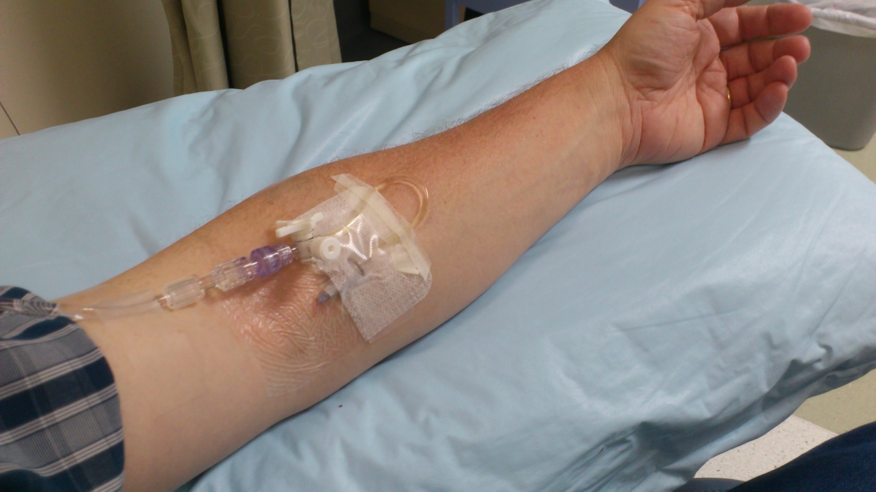 Antebraço com acesso venoso periférico e linha de infusão conectada em uso clínico durante infusão endovenosa de imunoglobulina (IVIG).