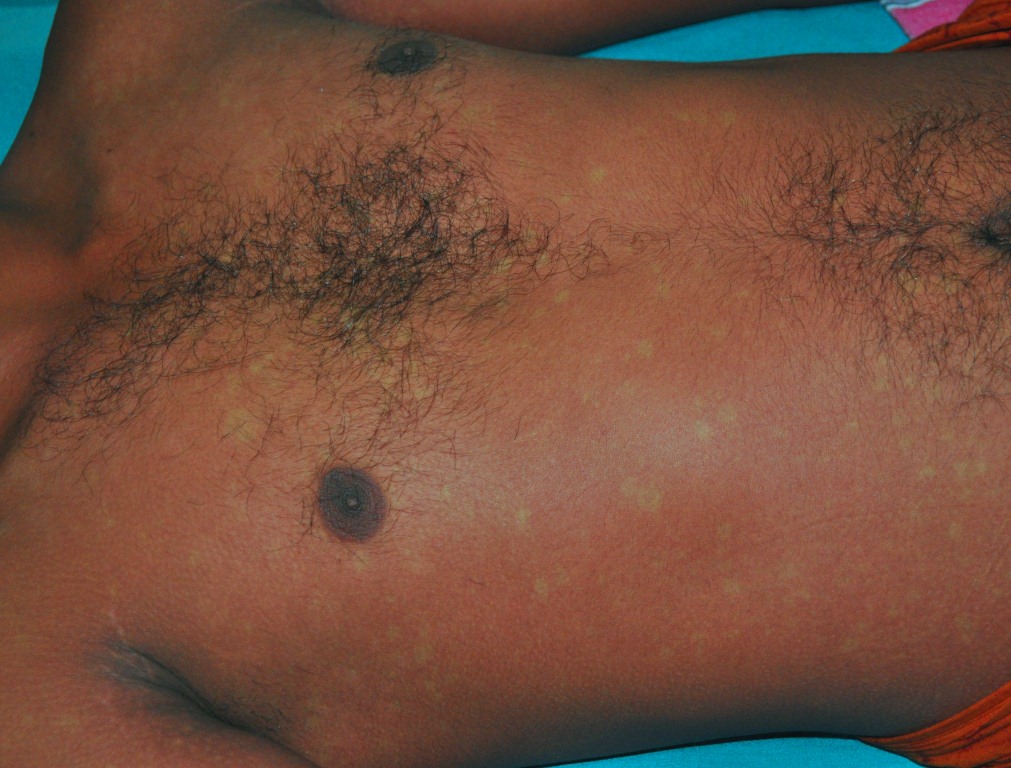 Fotografia clínica do tronco com eritema confluente e ilhas de pele poupada — rash clássico de recuperação da dengue (“islands of white in a sea of red”). Autor Ranjan Premaratna, CC BY-SA 4.0.