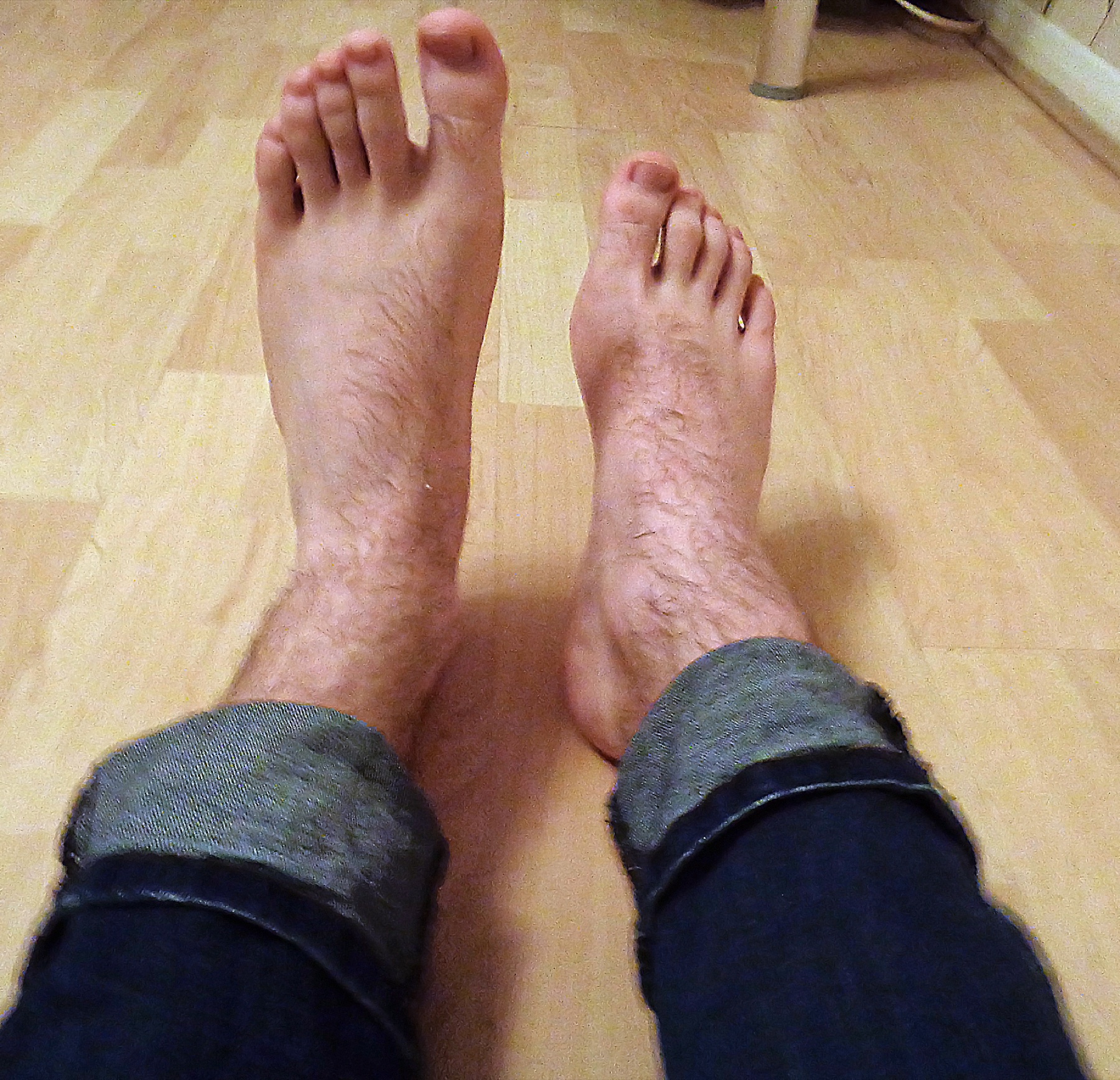 Foto clínica em visão superior dos pés de adulto: pé direito caído por paralisia do tibial anterior; pé esquerdo eleva com dorsiflexão preservada.