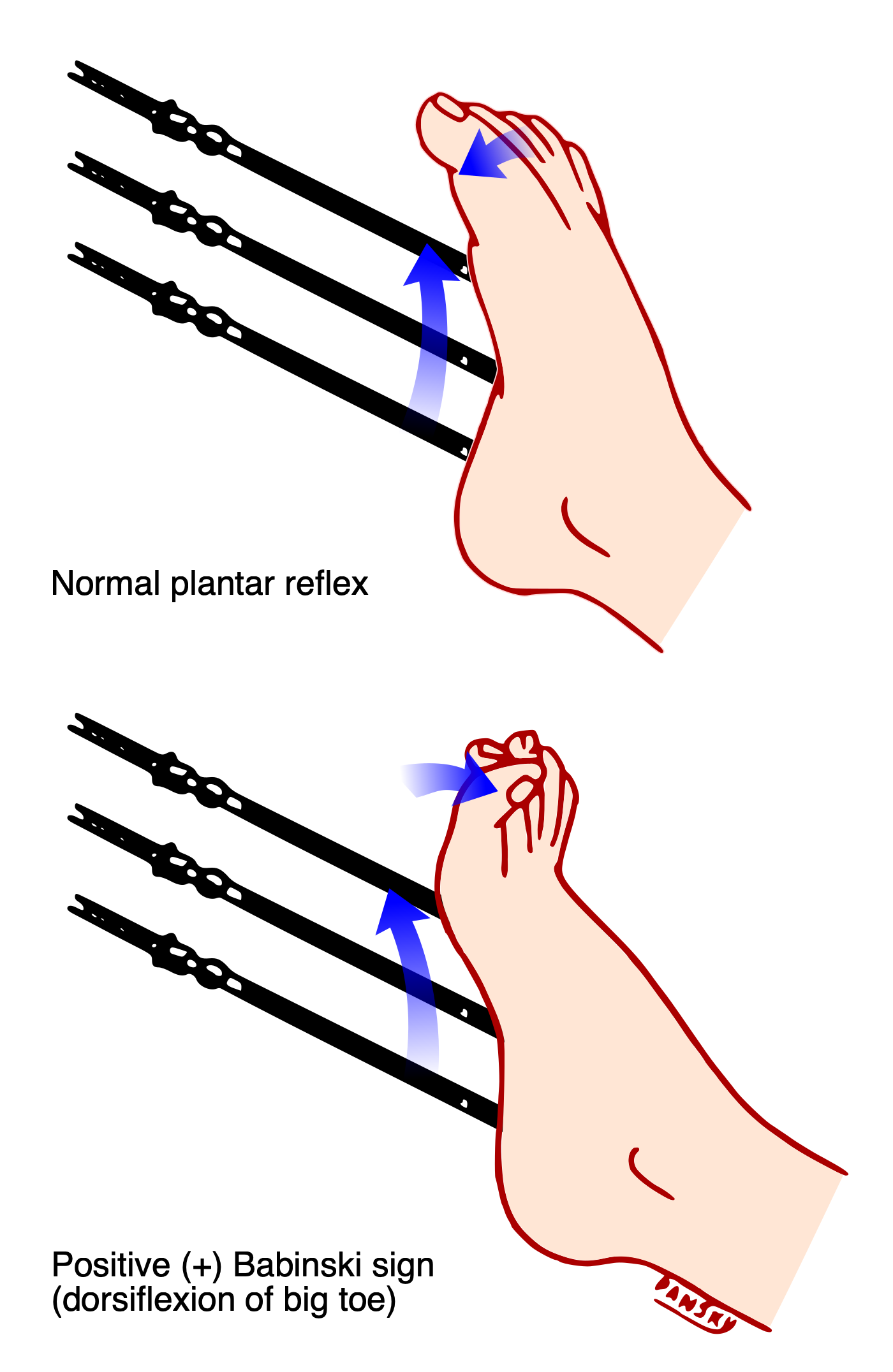 Diagrama em dois painéis do reflexo plantar: acima, resposta normal com flexão dos dedos; abaixo, sinal de Babinski positivo com extensão (dorsiflexão) do hálux e abertura dos demais dedos sob estímulo plantar.
