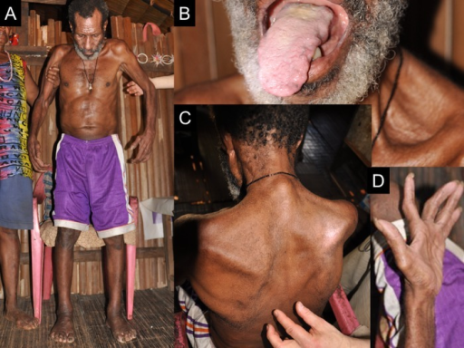 Paciente adulto com esclerose lateral amiotrófica: emagrecimento e atrofia muscular de membros com necessidade de apoio; atrofia avançada da língua; atrofia de cintura escapular e tronco, com sinal de Babinski; atrofia tenar avançada da mão.