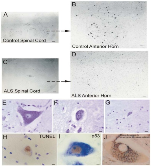 Histologia de medula: corno anterior controle com muitos motoneurônios grandes (A–B) versus corno anterior na ELA com depleção e neurônios atróficos (C–D); E–G mostram corpo do motoneurônio normal, atrófico e residual (Nissl).