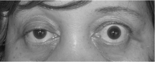 Foto clínica em olhar primário: ptose palpebral parcial à direita em adulto; pálpebra esquerda com pseudo-retração compensatória (lei de Hering).