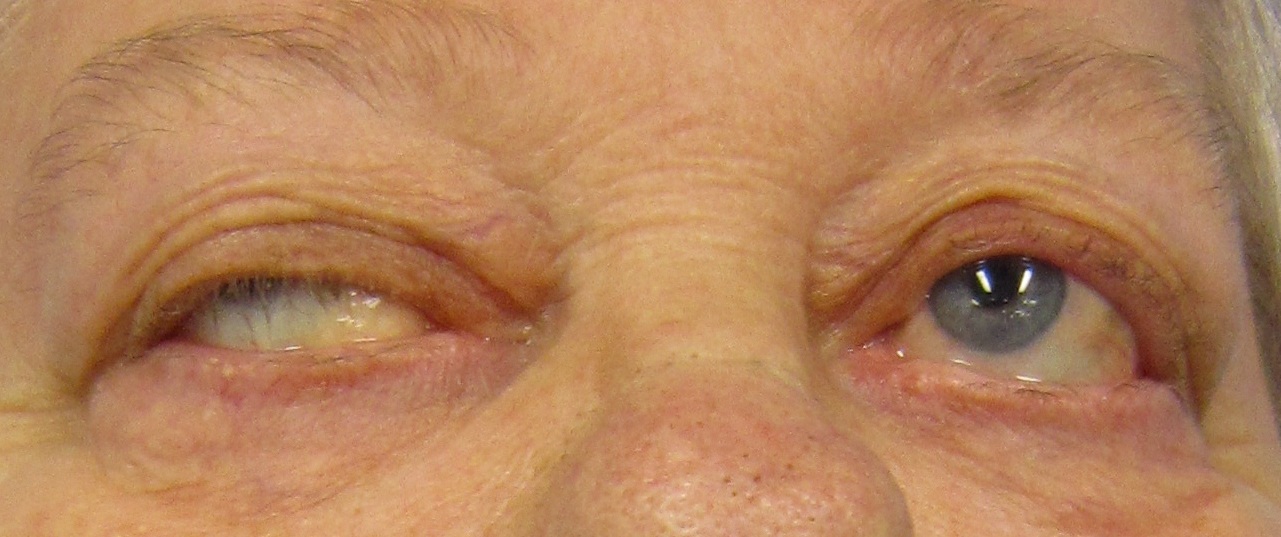 Foto clínica periocular de adulto com miastenia gravis: ptose grave à direita com olho direito em desvio e fenda estreita; olho esquerdo aberto, com pupila de calibre habitual no quadro.
