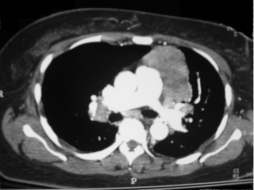 TC de tórax axial: grande massa necrótica no mediastino anterior esquerdo (timoma confirmado). Case courtesy of Kurukumbi M, Weir RL, Kalyanam J, Nasim M, Jayam-Trouth A.