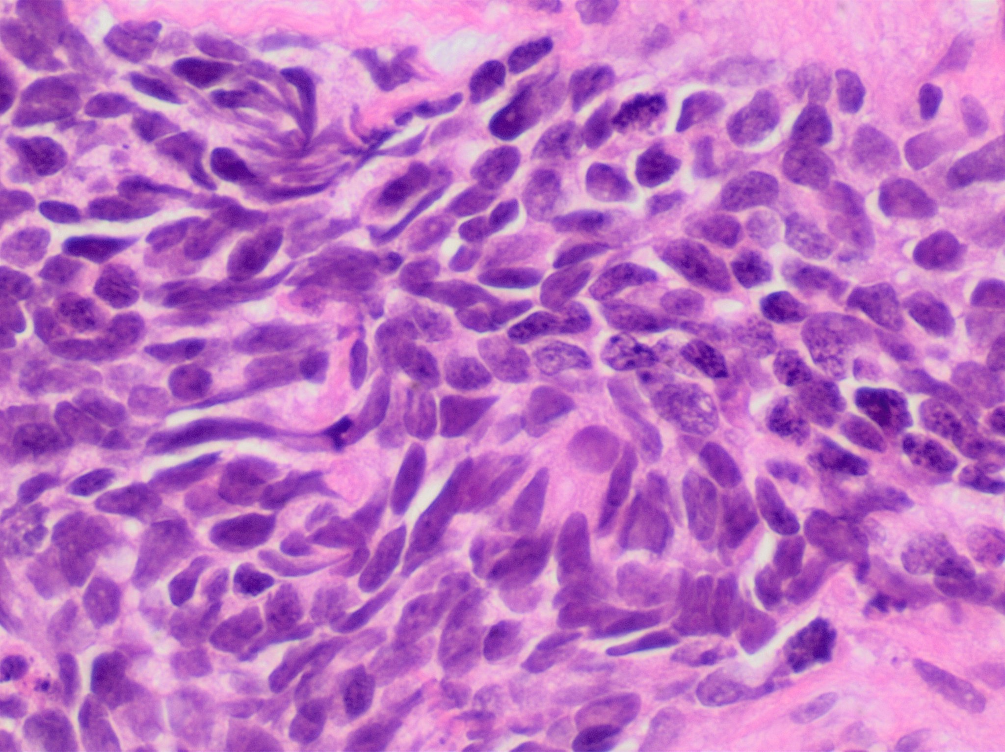 Histopatologia (H&E) de carcinoma de pequenas células de primário pulmonar (metástase de parede torácica). By Mikael Häggström, M.D.