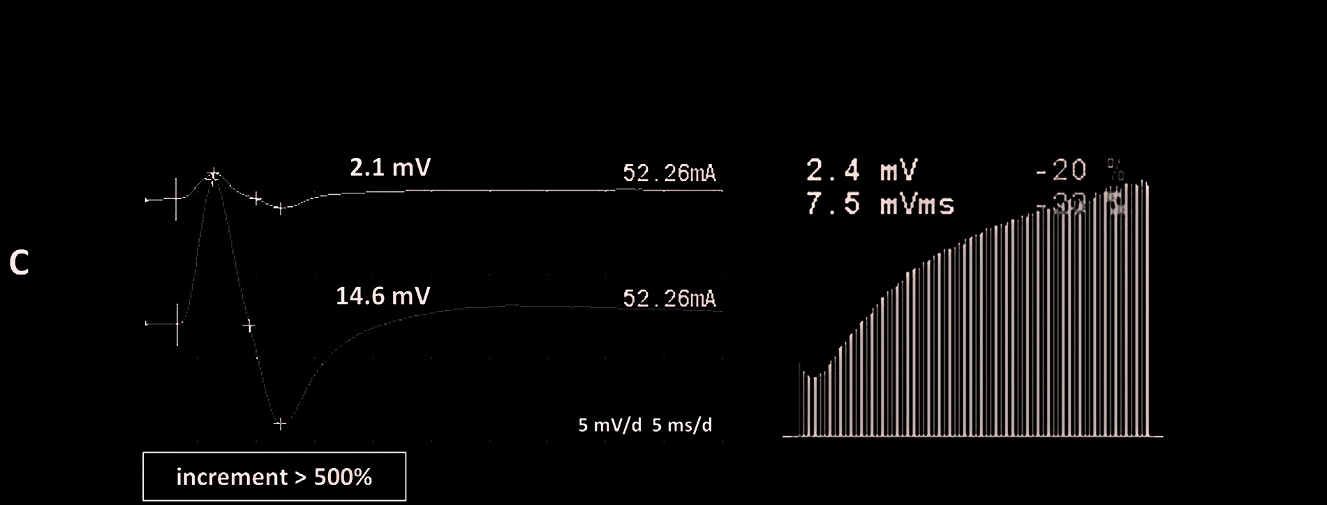 LEMS: CMAP com incremento >500% após esforço isométrico 10 s (2,1 → 14,6 mV; mediano → APB) e incremento em RNS 20 Hz (escada ascendente). Kouyoumdjian JA, Estephan EP. Arq Neuropsiquiatr 2023. Fig. 2C.